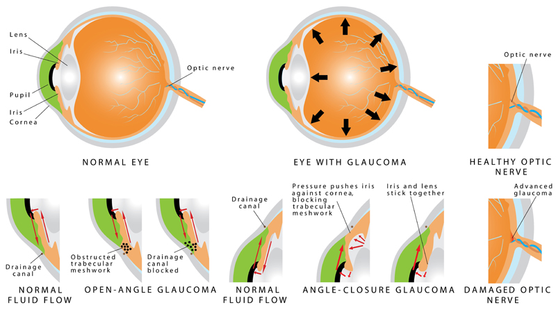 types of glaucoma